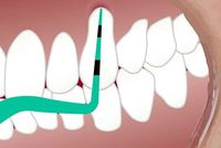 пародонтологична профилактика - 59530 типа | Medical Dent пародонтологична профилактика - 11438 типа