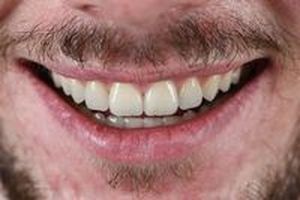 бондинг на зъби - 28183 възможности