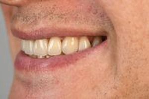 бруксизъм - 34890 разновидности