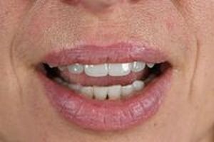 бруксизъм - 71410 награди