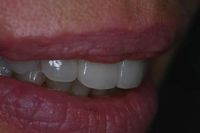 изтрити зъби - 50217 постижения