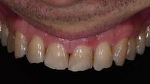 скърцане със зъби - 76067 снимки