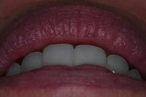 зъбни фасети - 64816 възможности