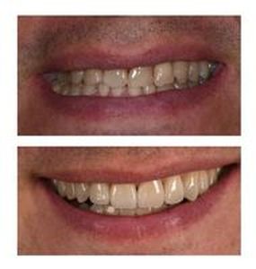 зъбни импланти - 30344 постижения