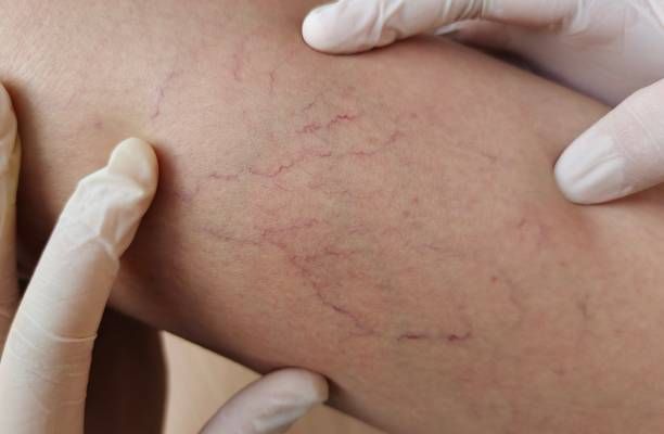 лечение на разширени вени - 59721 новини